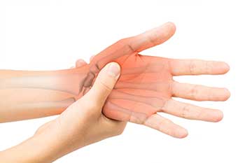 Hand with Arthritis Illustration
